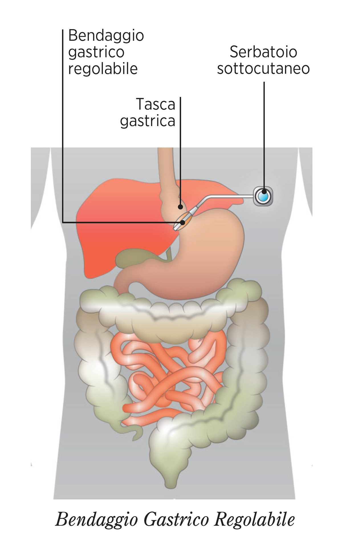 BENDAGGIO-GASTRICO-REGOLABILE