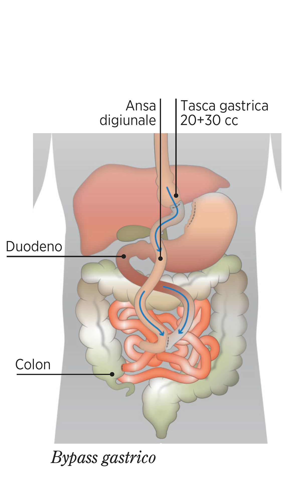 BYPASS-GASTRICO