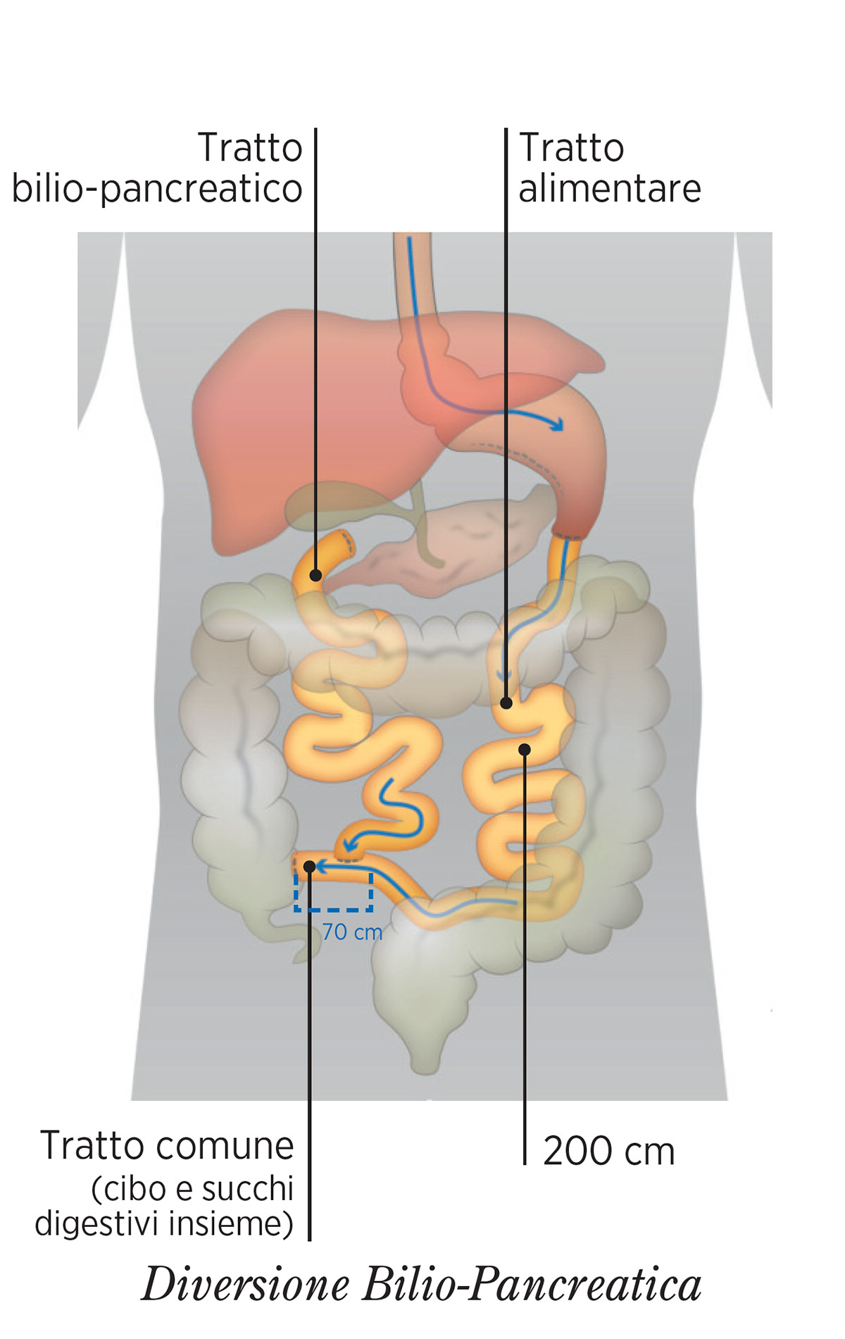 DIVERISONE-BILIO-PANCREATICA