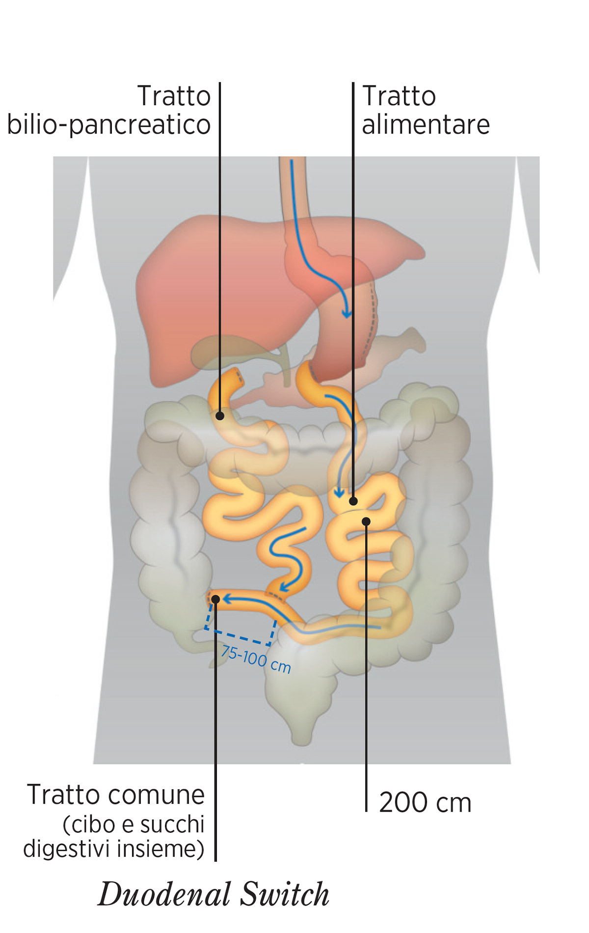 DUODENAL-SWITCH